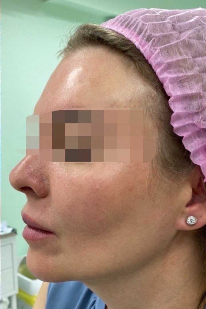 нити аптос, фото пациента после процедуры